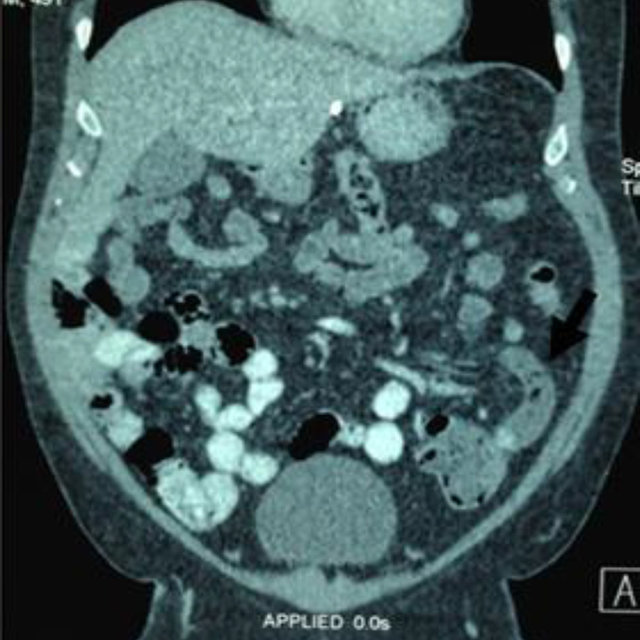 Coronal View Of The Abdominal Tomography Scan Acute Appendicitis In