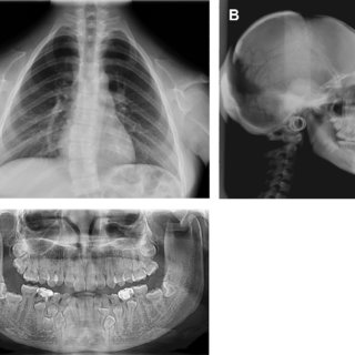 A. Chest radiograph of a 15-year-old female showing aplasia of