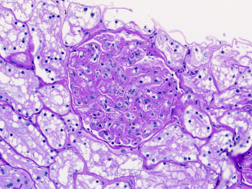 membranoproliferative glomerulonephritis