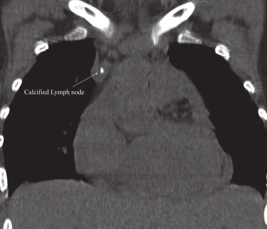 Computed Tomography: coronal view of the thorax; Calcified lymph node. Noncontrast coronal computed tomography scan shows hyperattenuation of paratracheal lymph nodes
