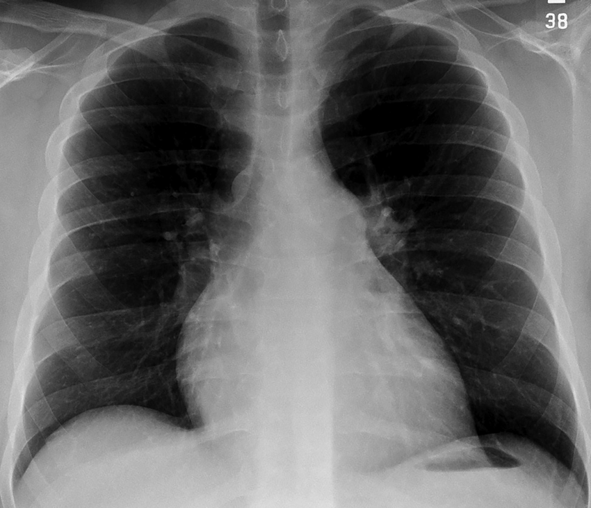Normal chest x-ray with no infiltrate or plural effusion ...