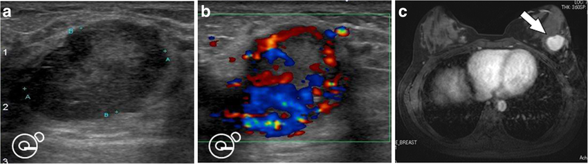 Ultrasonography and MRI image findings: The mammary tumor was revealed as a hypoechoic, internally heterogeneous mass measuring 22.4 × 16.2 × 21.1 mm (a) with a rich blood supply (b) using ultrasonography, while magnetic resonance imaging findings identified a 3-cm tumor larger than that found on prior imaging (c) (arrow)