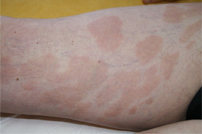 Mycosis fungoides “patches” stage.