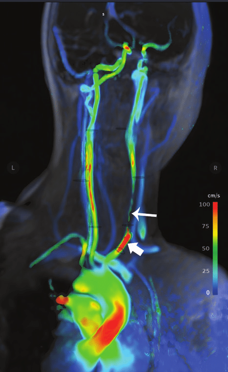 Four-dimensional flow MRI covering the thoracic aorta and cerebral ...