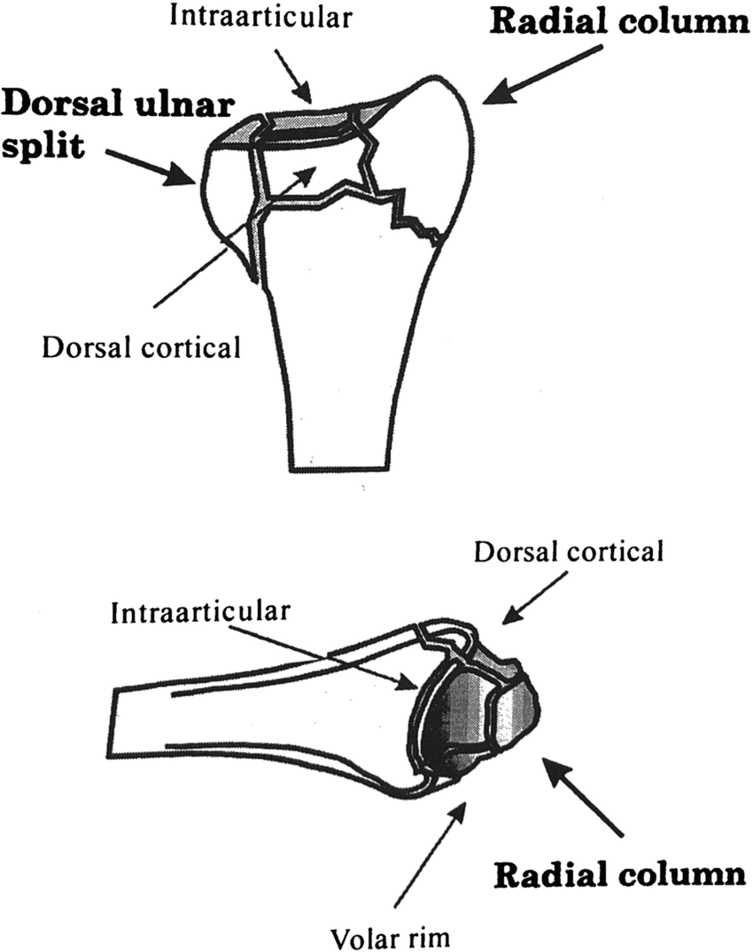 The commonly seen articular fragments in intra-articular distal radius fractures