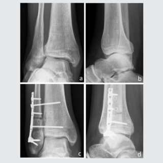 Ankle joint re-balancing in the management of ankle fracture