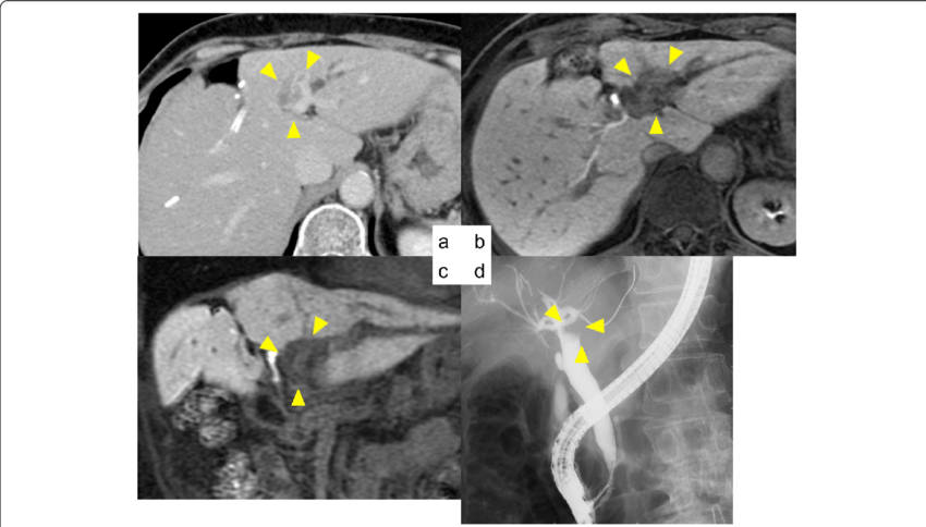 a Contrast-enhanced CT scan revealed dilation of left intrahepatic bile duct (8 mm) and a high-density mass in segments II and III. b, c MRCP also revealed a 20 × 14 mm mass in segments II and III. d ERCP revealed a shadow defect in segments II and III. No other tumor or defect was detected
