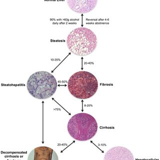 liver cirrhosis pathology