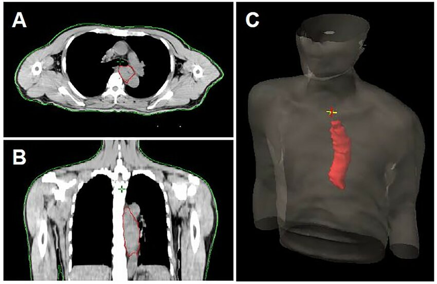 The representative images of primary tumor volume calculation. (A) The cross-sectional area of tumor was circumscribed by red line. (B) The sagittal area of tumor was circumscribed by red line. (C) The 3D construction of primary tumor volume. https://doi.org/10.1371/journal.pone.0237114.g001