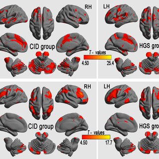 Pdf Altered Long And Short Range Functional Connectivity Density Associated With Poor Sleep Quality In Patients With Chronic Insomnia Disorder A Resting State Fmri Study