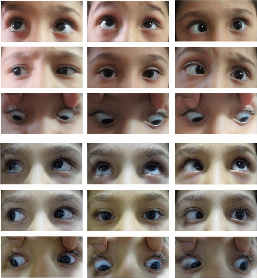 Duane syndrome of the left eye. Upper panel, before surgery in the left eye. Lower panel, after surgery in the left eye. Esotropia and face turn were markedly reduced and abduction improved
