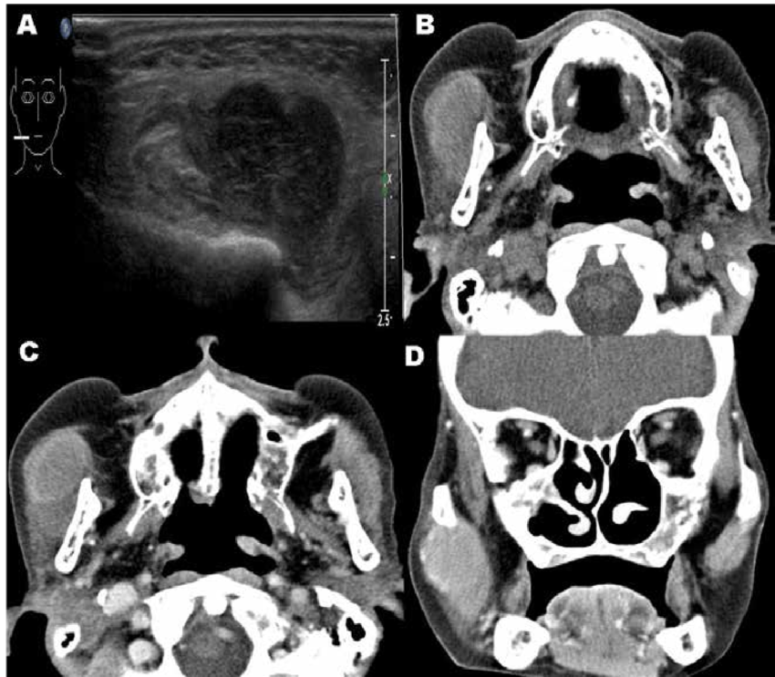 Us A Showed 23cm Sized Intramasseter Mass Lesion And Ct Scans B