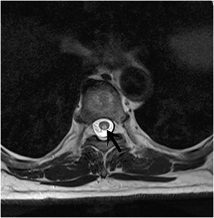 Spinal magnetic resonance imaging of a 58-year-old male patient that presented with numbness in the lower extremities for the past 7 months. The patient had adhered to a vegetarian diet without meat for approximately 10 years. Axial T2-weighted imaging of the spinal cord at the T3 level demonstrated bilateral symmetric signal intensity within the dorsal and lateral columns (inverted V sign) (arrow).