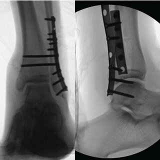 Ankle joint re-balancing in the management of ankle fracture