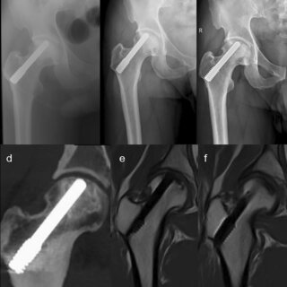 132 months follow-up of a patient with osteonecrosis of the femoral ...
