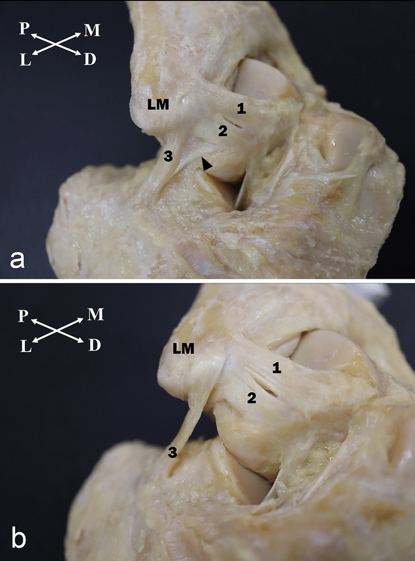 The ligament anatomy of the deltoid complex of the ankle: a qualitative and  quantitative anatomical study.