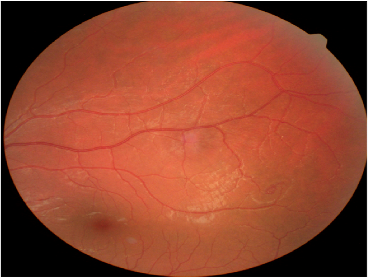 Fundus photograph of the left eye showing a micro angioma in front of a superior temporal retinal artery branch.