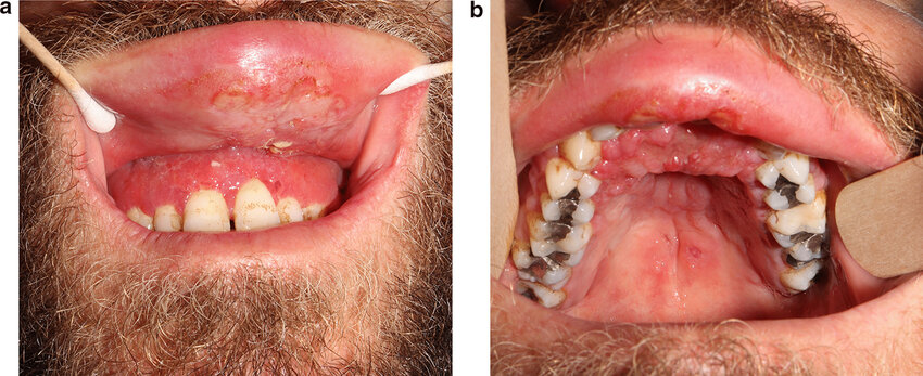 Maxillary gingival hyperplasia and upper lip polypoid swelling and superficial ulcerations in its inner aspect (a). progression of the lesions and involvement of the palatal gingiva and hard palate, and ulcerations in the soft palate (b)