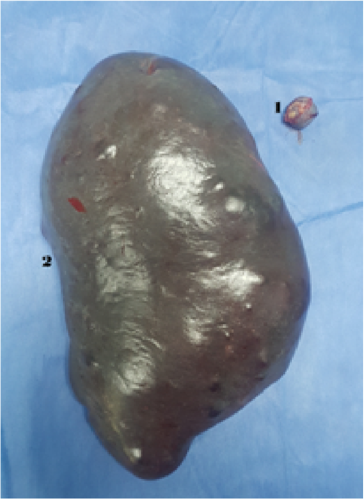 Image showing 1: liver biopsy 2: splenectomy. | Download Scientific Diagram