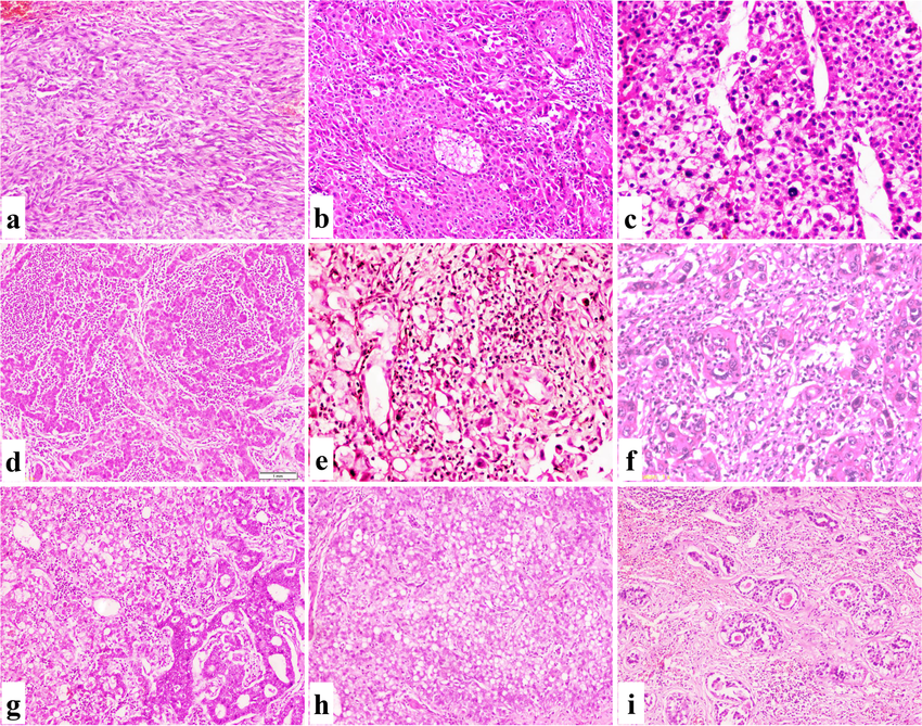 Microscopic Aspects Of Special HCC Variants Continued A A Sarcomatoid Download Scientific