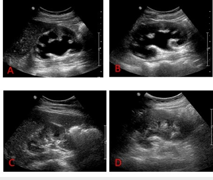 Severe Bilateral Hydronephrosis Noted Right A And Left B Kidneys