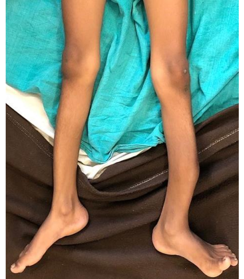 patient was in supine position showing angular curvature of tibia of left leg