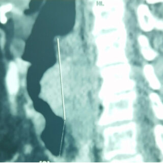 Figure 1. Computed tomography, sagittal section, revealing the occlusive lesion of the larynx measuring 3.7 centimetres