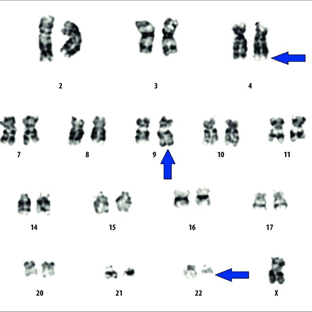 Chromosomal analysis revealed the presence of variant Philadelphia