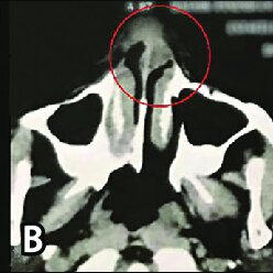 Anterior rhinoscopy findings; A. Patent right nasal cavity; B. Smooth