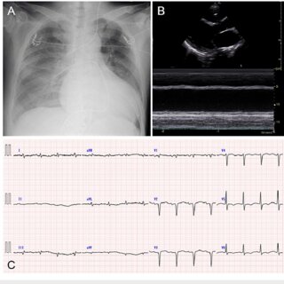 FIGURE 1: Chest radiography (A), echocardiography (B), and 12-lead electrocardiography (C) on admission