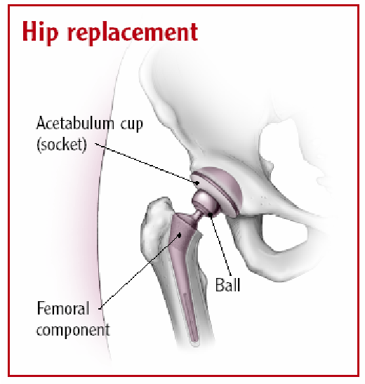 Total hip joint replacement  Download Scientific Diagram