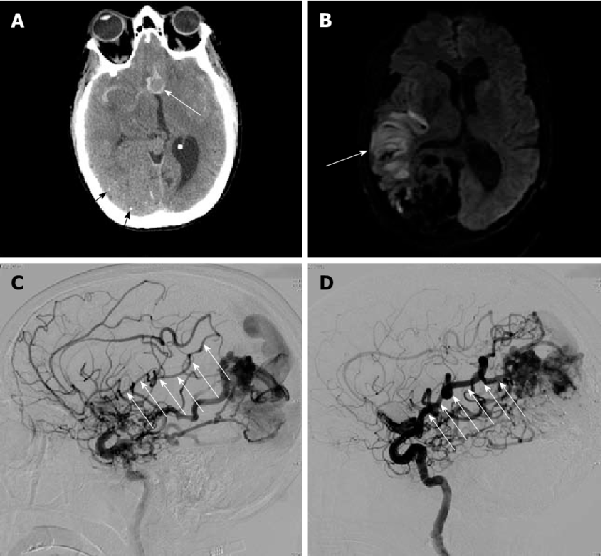 A 47-year-old woman with ruptured anterior communicating artery 