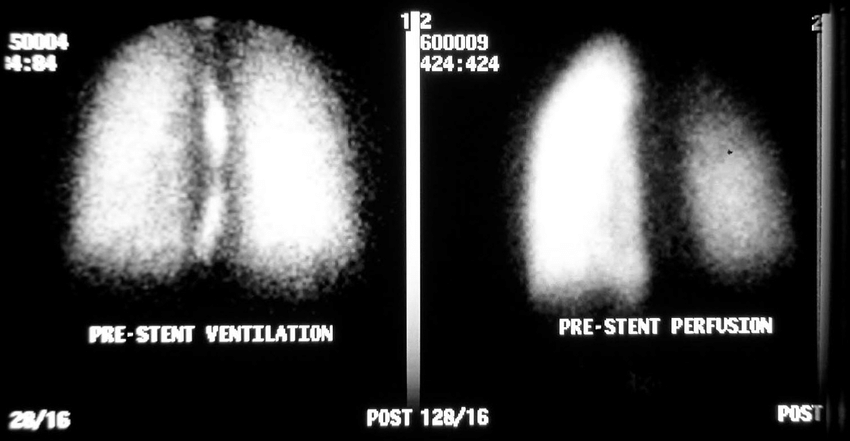 Ventilation and perfusion scan (posterior view) of the lungs before stent insertion, showing 78.5% perfusion to the left lung, 21.5% perfusion to the right lung and normal ventilation 