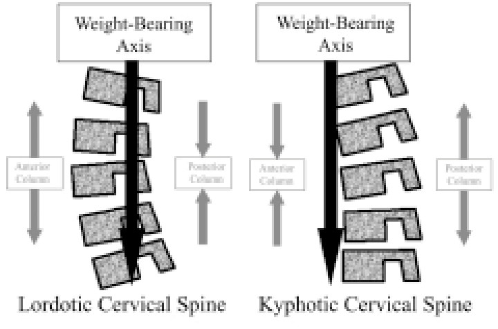 The type of cervical curvature according to the lateral cervical